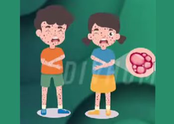 Cacar Monyet Bisa Menular dalam Jarak 5 Mil?