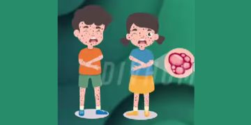Cacar Monyet Bisa Menular dalam Jarak 5 Mil?