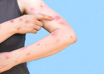 Meski Mirip, Ini Perbedaan Cacar Monyet dengan Cacar Air