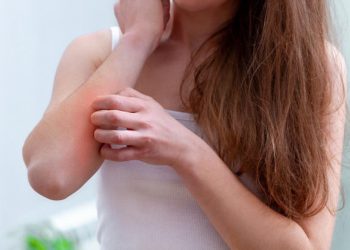 Kulit Tidak Nyaman Karena Gatal-gatal? Atasi dengan 7 Bahan Alami Ini