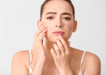 Dikira Jerawat Biasa Ternyata Fungal Acne, Apa Pemicu dan Perbedaannya?