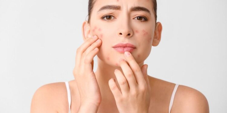 Dikira Jerawat Biasa Ternyata Fungal Acne, Apa Pemicu dan Perbedaannya?