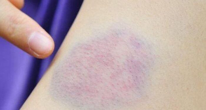 Cek Warna Kulit dan Bentuk Kuku, Bisa Jadi Pertanda Penyakit Jantung