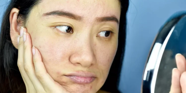 Kulit Rusak Akibat Pakai Pemutih? Jangan Sedih, Terapkan Cara Ini Agar Kinclong Lagi