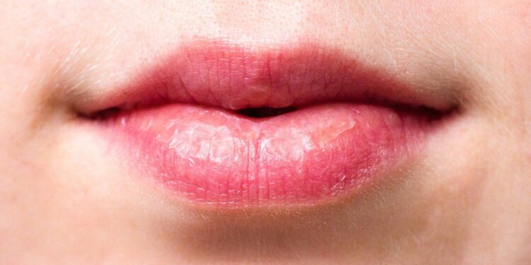 Enam Tips Cegah Bibir Kering dan Pecah-Pecah saat Puasa di Bulan Ramadan