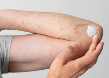 Waspada Penyakit Kulit dari Alergi dan Infeksi Akibat Banjir