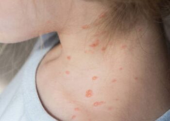 Wabah Campak di Amerika Makin Buruk, Dua Anak Meninggal Dunia