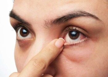 Empat Gejala Penyakit Ginjal yang Terlihat pada Mata