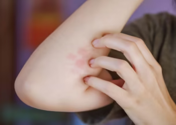 Apa Itu Post Herpetic Neuralgia? Kenali Gejala dan Cara Mengatasinya