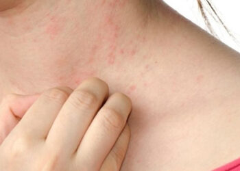 Alergi Dingin Tak Bisa Sembuh Total, Berikut Fakta dan Cara Mengatasinya