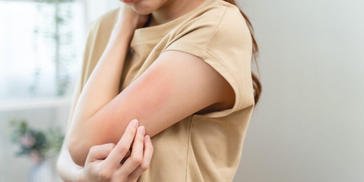 Jangan Sepelekan Kulit Gatal, Bisa Dipicu Defisiensi Vitamin dan Nutrisi
